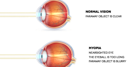 nearsightedness diagram